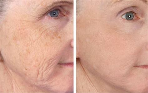 The Award Winning Picosure For The Treatment Of Wrinkles Is Now Fda