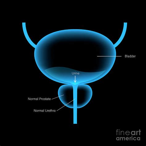 Benign Prostatic Hyperplasia Photograph By Pikovit Science Photo