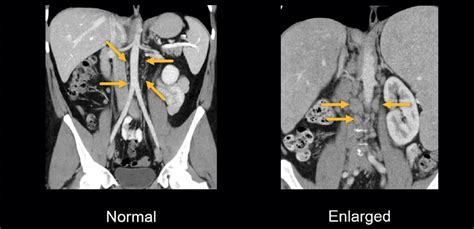 Ct Scan Enlarged Lymph Nodes