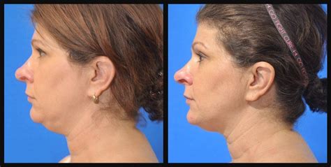Coolsculpting Before And After Photo Gallery Dr Kane