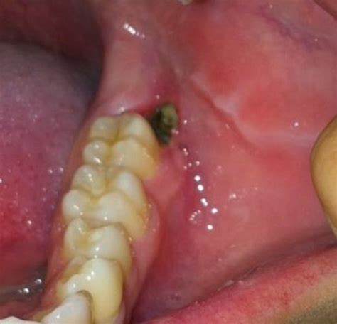 Wisdom Tooth Infection Symptoms Causes Treatment Pictures