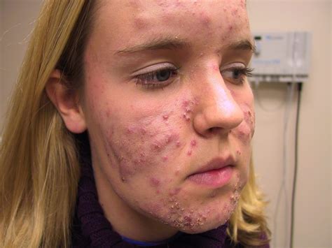 Homeopathy for Acne Treatment | Homeopathic Acne Treatment