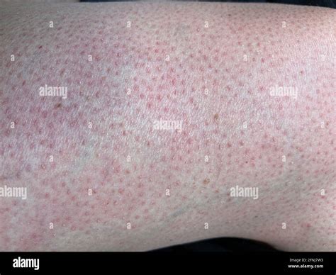 Heat Rash Hives Allergy Reaction On Knee Close Up Reference Picture Of