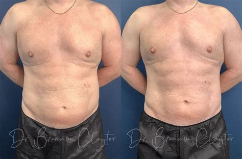 3 Stubborn Areas Of Fat Men Can Freeze Away With Coolsculpting Claytor Noone