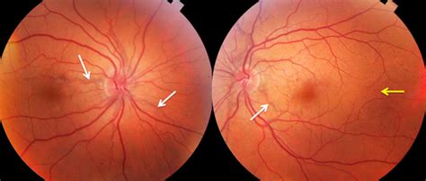 Angioid Streaks Asymptomatic Case The Retina Reference