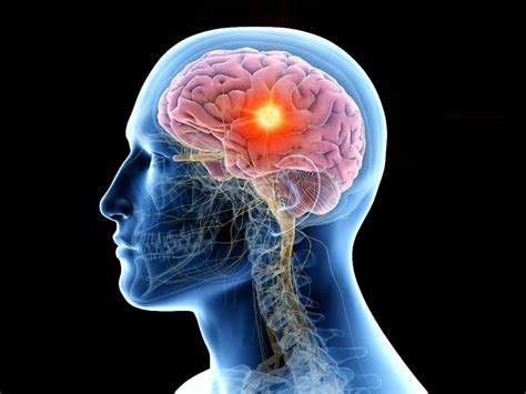 Understanding Brain Tumors New Brunswick Nj Patch
