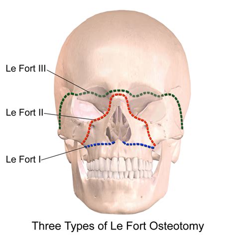 What Is A Le Fort I Osteotomy ArchWired
