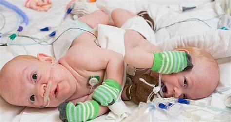 Conjoined Twins Separated In 12 Hour Operation Video Canada Journal