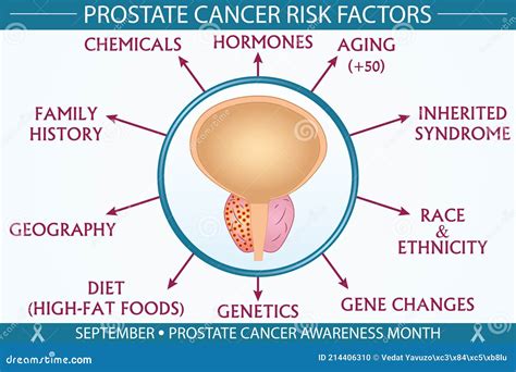 Prostate Cancer Disease Risk Factors Infographic Vector Illustration