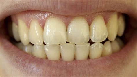 Causes And Treatment Of Most Common Teeth Stains Top Rated Cosmetic