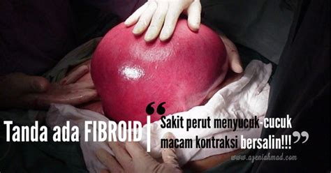 Mereka bergantung kepada saiz dan lokasi struktur. Size Fibroid 13.3cm Jadi 0cm! Apa yang Berlaku ...