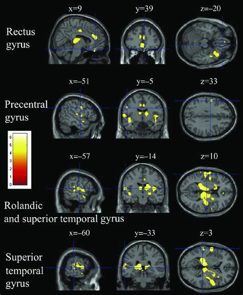 Grey Matter Density Decrease In Patients With Chronic Obstructive