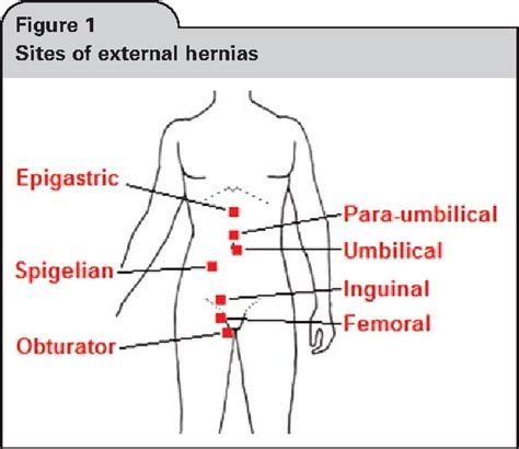 Figure From Nomenclature In Abdominal Wall Hernias Is It Time For