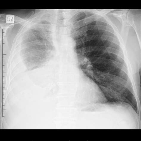 However, the presence of a pleural effusion could also. Mesothelioma | Image | Radiopaedia.org