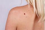Images of What Doctor To See For Moles