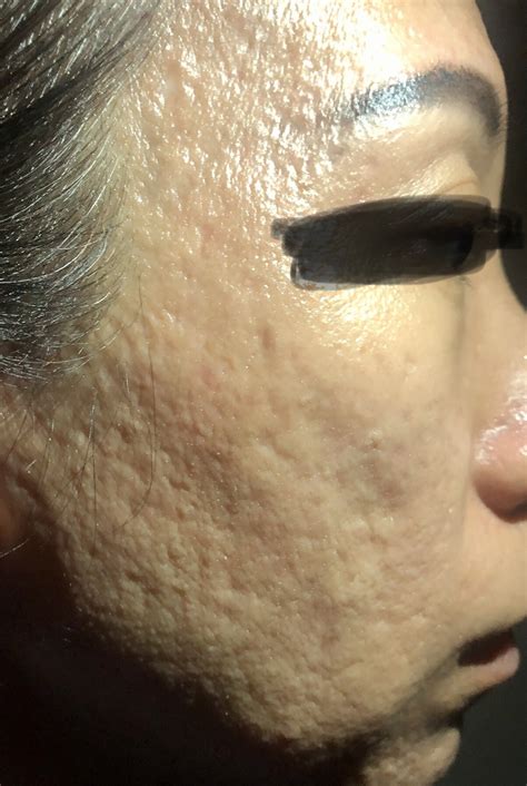 Asian Lady With Severe Acne Scars Need Opinion For Sutaible Treatment
