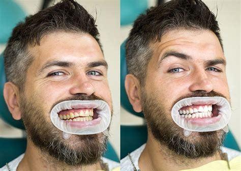 Teeth Whitening Brisbane Zoom Whitening Service Good Dentists