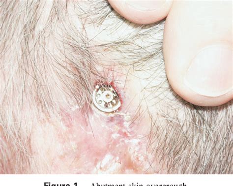 Figure 1 From Bone Anchored Hearing Aid Abutment Skin Overgrowth