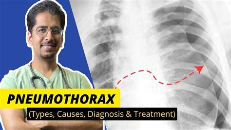 Pneumothorax Types Causes Diagnosis Treatment Detailed Video Youtube