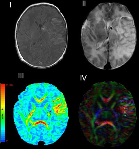 Diffusion Tensor Imaging A Magnetic Resonance Image Of A Term Infant Download Scientific