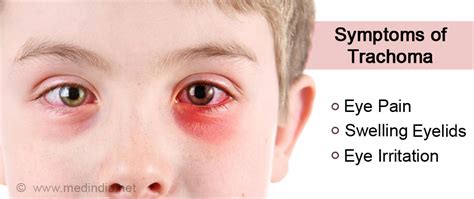 Trachoma Causes Symptoms Complications Diagnosis Treatment