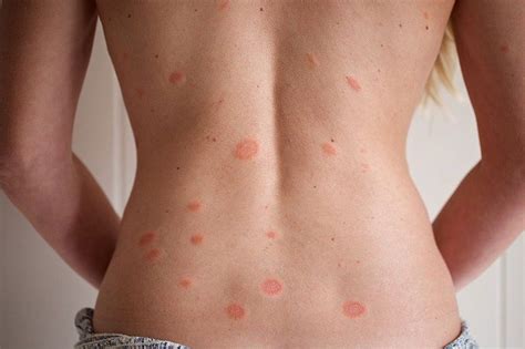 How to treat a razor rash on the neck? Pin on Slimming