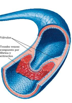 En la trombosis venosa superficial el trombo se forma dentro de las venas superficiales que se encuentran directamente debajo de la superficie de la piel. CMC Y FYQ: ENFERMEDADES CARDIOVASCULARES