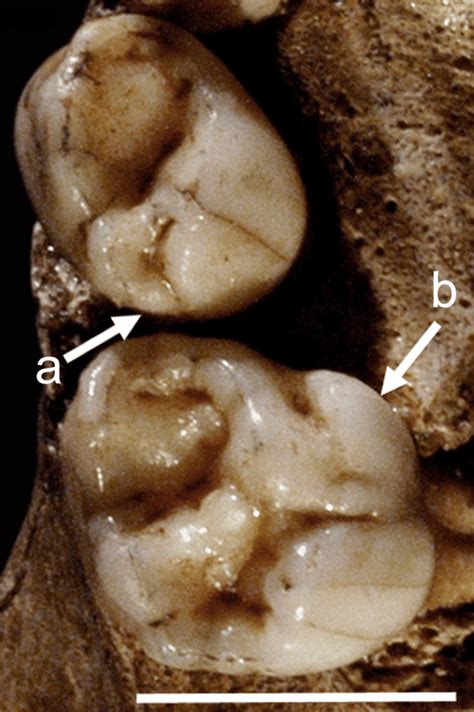 The Roc De Marsal Right Maxillary Deciduous First And Second Molars Dm