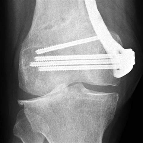 Fitting Of The Tomofix Medial Distal Femoral Plate Mdf Depuy Synthes