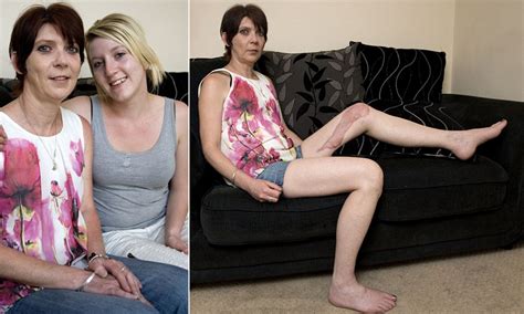Debbie Woolhead Survives Deadly Flesh Eating Bacteria After Falling On