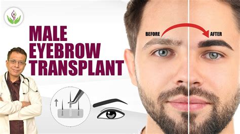 male eyebrow transplant आईब्रो ट्रांसप्लांट procedure in delhi care well medical centre