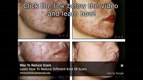 Watch How To Cure Acne Naturally Best Treatment For Acne Based On The Latest Scientific