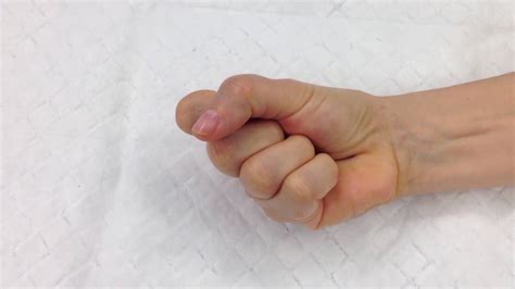 Trigger finger or also called the stenosing tenosynovitis is a medical condition in which a finger is stuck in a bent position. Trigger Finger - YouTube