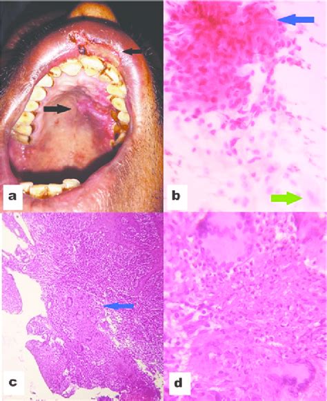 Primary Oral Tubercular Lesion A Photograph Of Case 1 Showing Ulcer