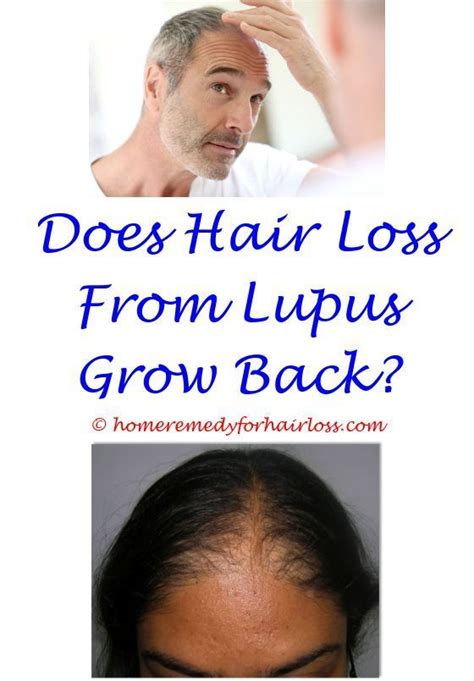 How To Stop Lupus Hair Loss