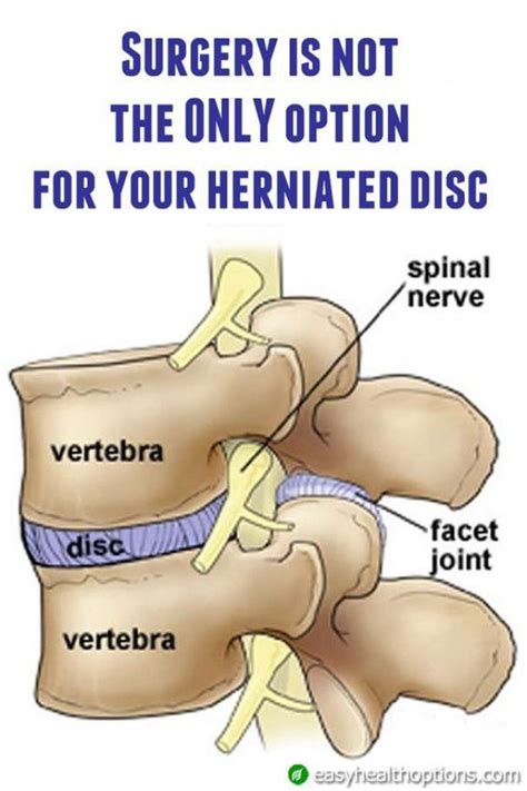Pin On Herniated Disc