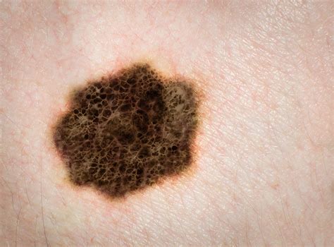 Melanoma Skin Cancer Moles