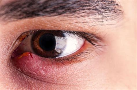 Stye On Eye 10 Causes Of Stye On An Eye