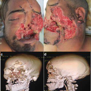 Extensive crush degloving injury of the face with composite loss of ...
