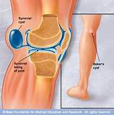 Photos of Knee Plica Treatment
