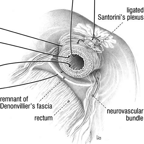 Nerve Sparing Open Radical Retropubic Prostatectomy European Urology