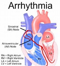 Image result for arrhythmia