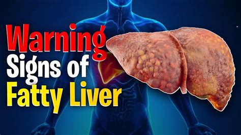 Don T Ignore These Warning Signs Of Fatty Liver Youtube
