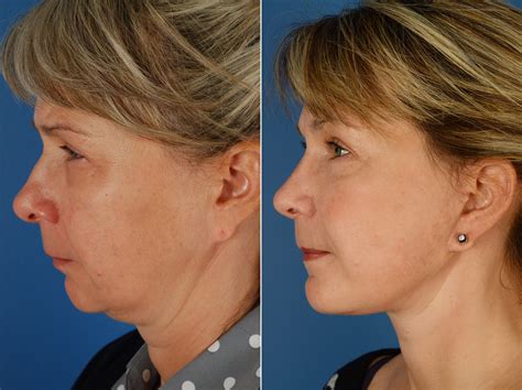 The Uplift Lower Face And Neck Lift Photos Naples Fl Patient 11611