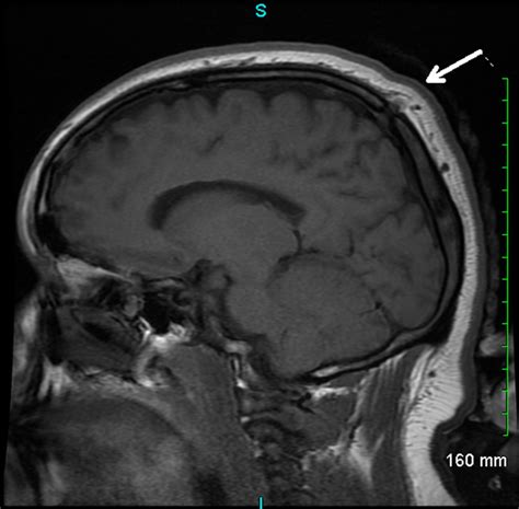 Sinus Pericranii In A Young Adult With Chronic Headache Bmj Case Reports