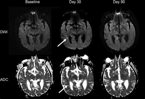 Neuroimaging Demonstration Of Evolving Small Vessel Ischemic Injury In