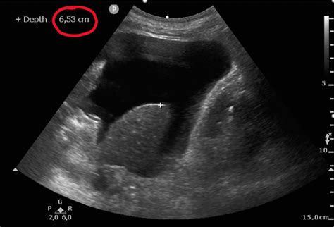 Winfocus Should Ultrasound Guided Paracentesis Be Obligatory For The