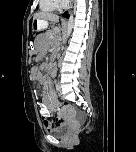 Abdominal Lymphoma With Sandwich Sign Image