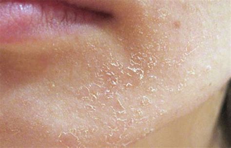 Почему шелушится кожа на лице и что с этим делать