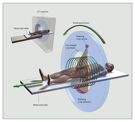 Computed Tomography — An Increasing Source Of Radiation Exposure Nejm